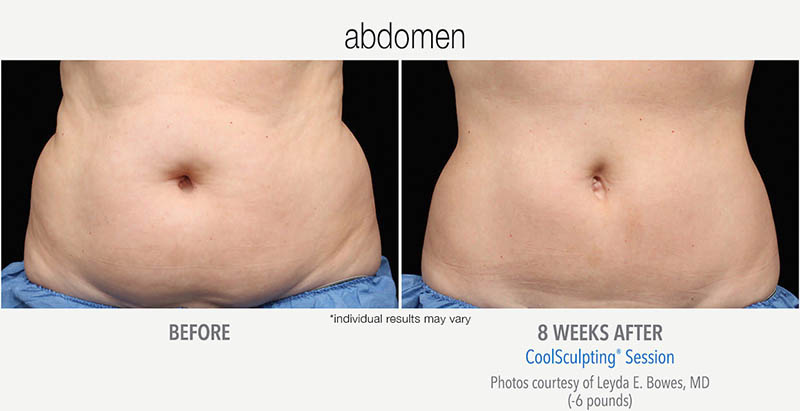 CoolSculpting Before and After Abdomen