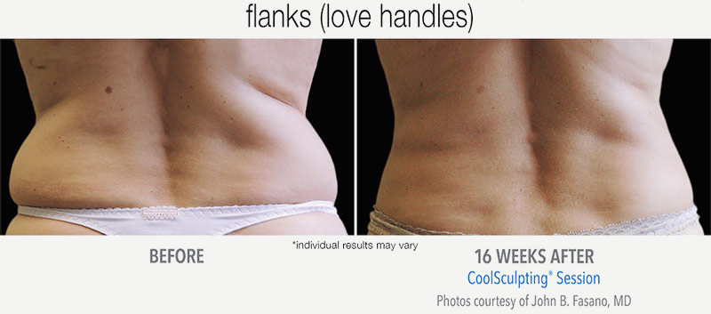 CoolSculpting Before and After Sides