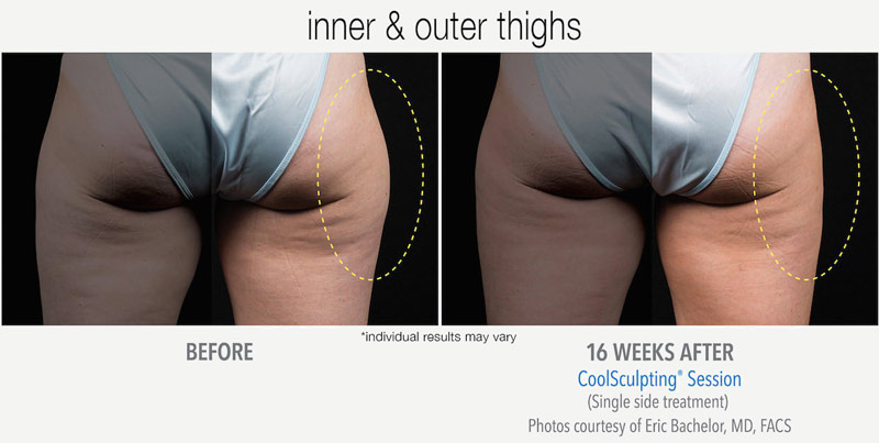 CoolSculpting Before and After Hips